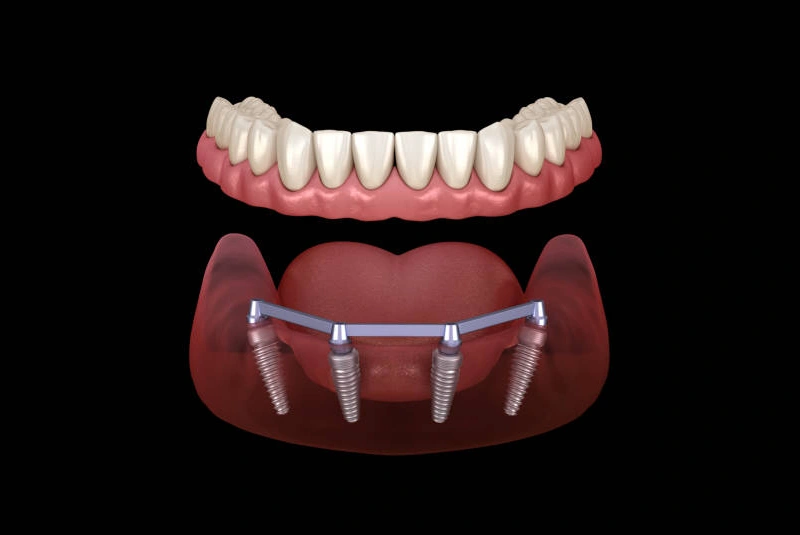 Candidacy - All-On-4 Dental Implants in The Woodlands, TX
