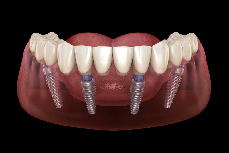 All-On-4 Dental Implants in The Woodlands, TX - Dentistry and Orthodontics