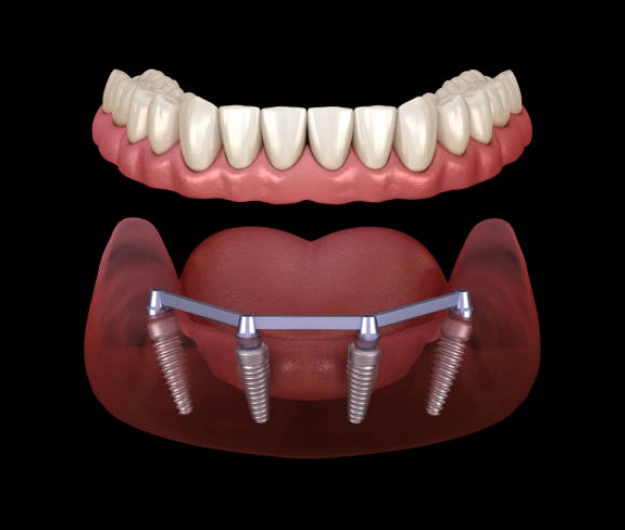 All-on-4® Dental Implants - The Woodlands, TX - Dentistry and Orthodontics