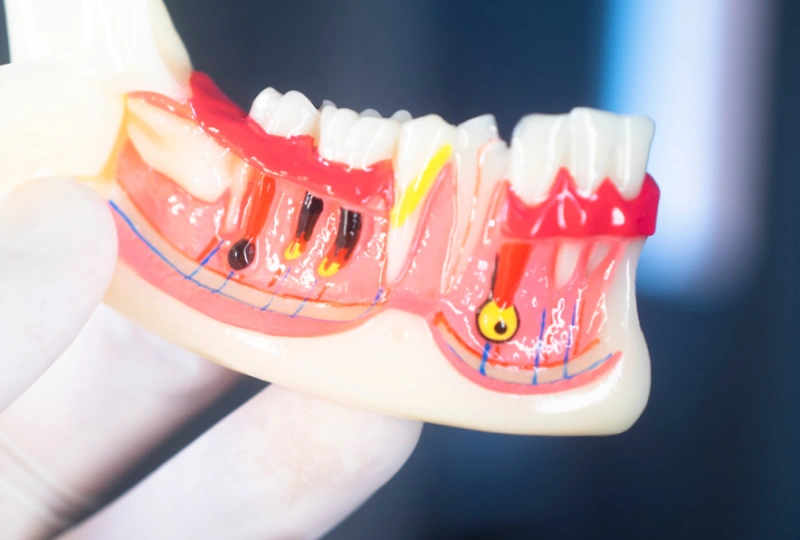 Reasons - Apicoectomy in The Woodlands, TX