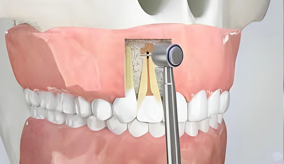 Apicoectomy - The Woodlands, TX - Dentistry and Orthodontics