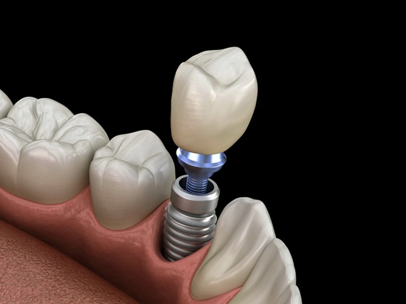 Single Tooth Implants & Bridges