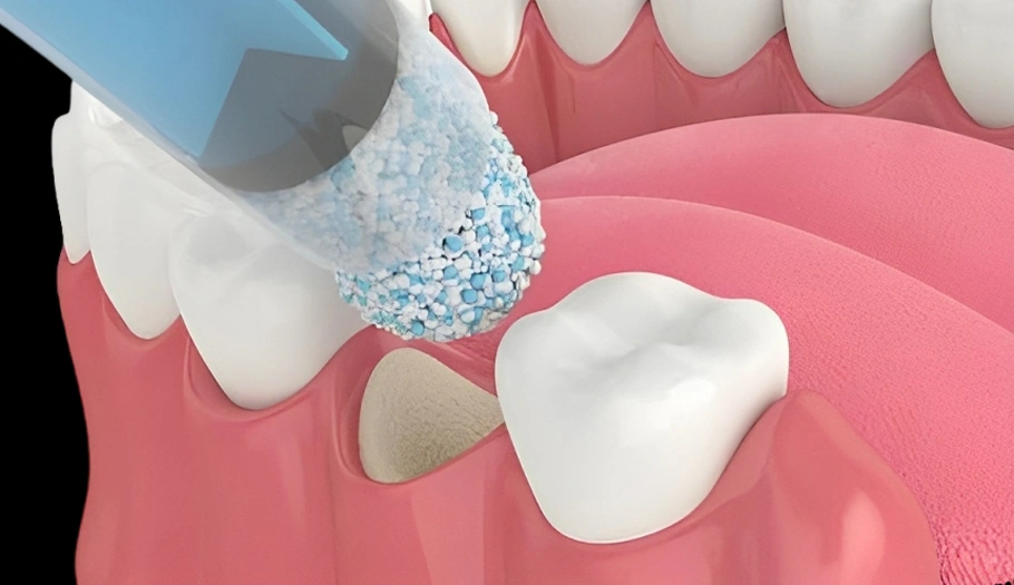 Bone Grafting - The Woodlands, TX - Dentistry and Orthodontics