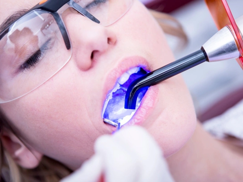Procedure - Composite Fillings in The Woodlands, TX