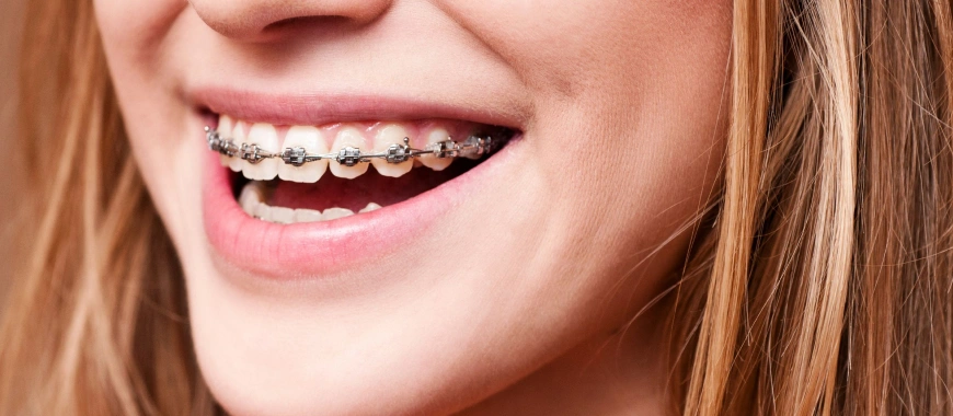 Damon Braces - The Woodlands, TX - Dentistry and Orthodontics