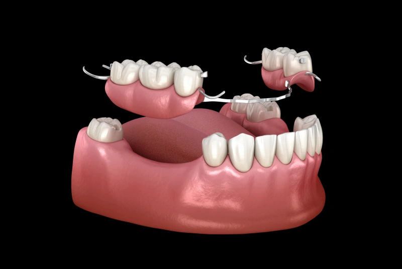 Benefits - Dental Bridges in The Woodlands, TX
