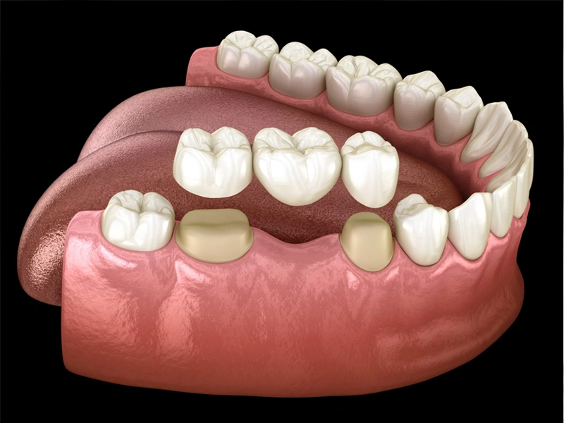 Dental Bridges in The Woodlands, TX - Dentistry and Orthodontics