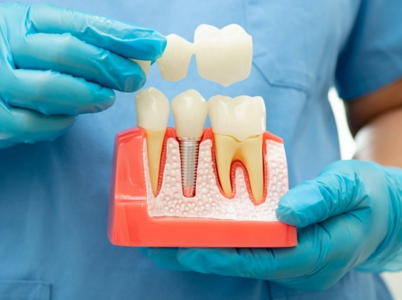 Dental Crowns in The Woodlands, TX - Dentistry and Orthodontics
