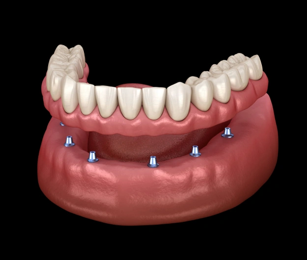 Hybrid Implant Dentures - The Woodlands, TX - Dentistry and Orthodontics