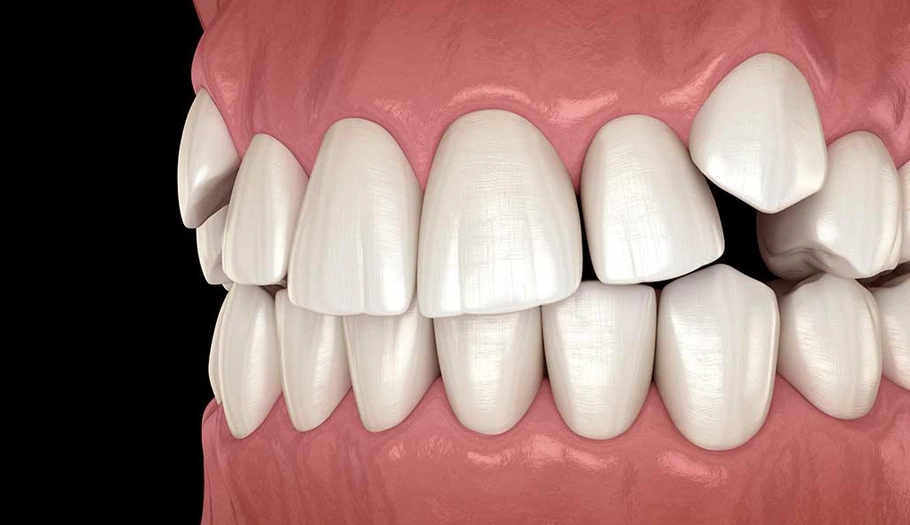 Impacted Canines - The Woodlands, TX - Dentistry and Orthodontics