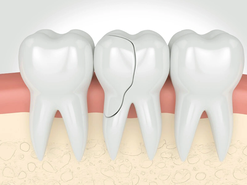 Reasons - Composite Fillings in The Woodlands, TX