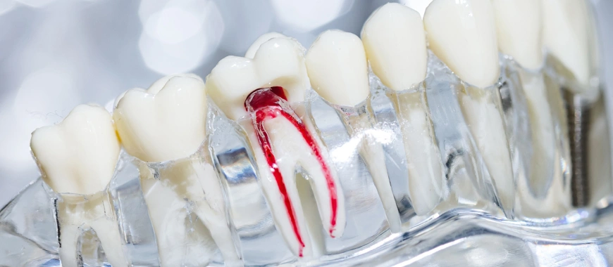 Root Canal Retreatment - The Woodlands, TX - Dentistry and Orthodontics