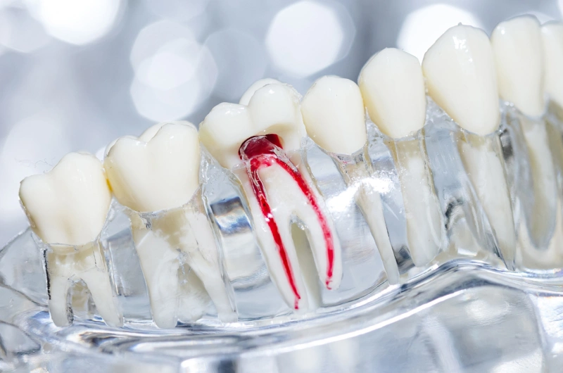 Reasons - Root Canal Therapy in The Woodlands, TX