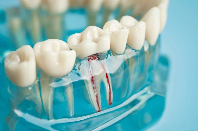 Signs and Symptoms - Root Canal Therapy in The Woodlands, TX