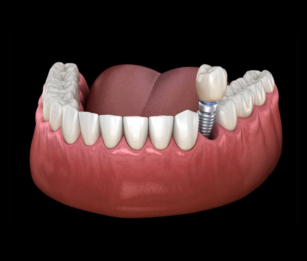 Single Dental Implant - The Woodlands, TX - Dentistry and Orthodontics