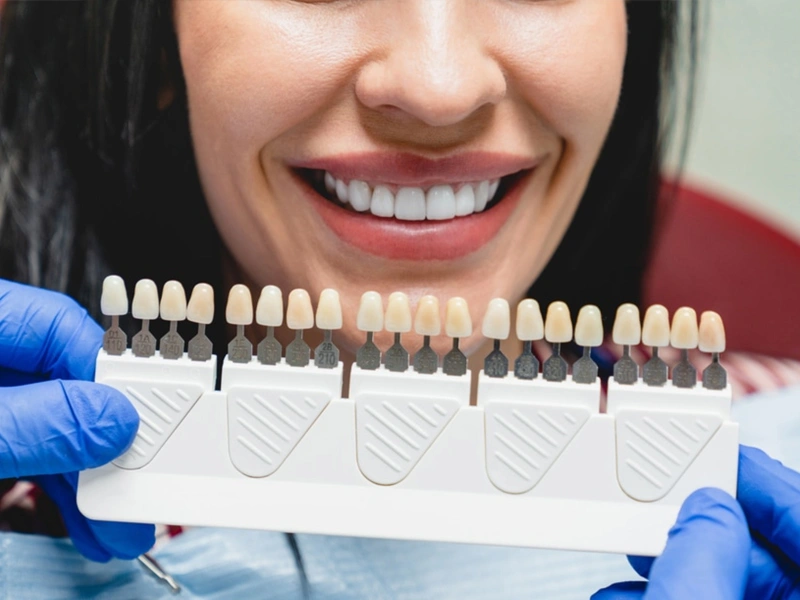 Longevity - Veneers in The Woodlands, TX